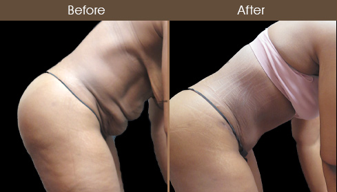 Before And After Tummy Tuck Surgery In NYC