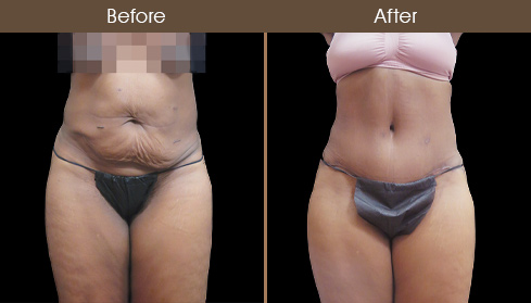Before And After Tummy Tuck In NYC