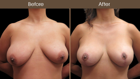 Breast Lift With Breast Augmentation Before And After