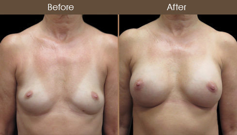 Before & After Breast Implant Surgery