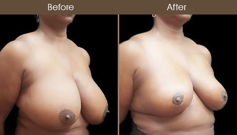 NYC Breast Reduction Before And After
