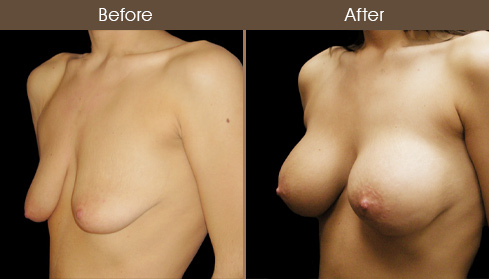 Before And After Mastopexy Surgery