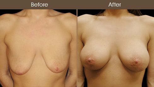 Before And After Mastopexy