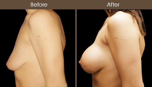 Breast Lift Before And After Side View