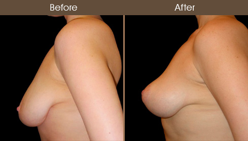 Before & After Mastopexy