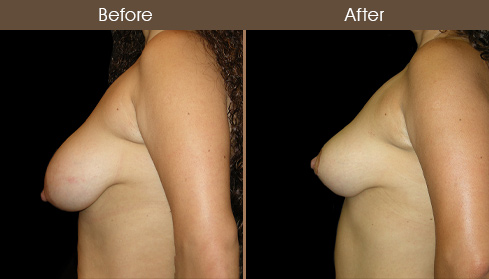 Breast Reduction Surgery Before And After Left Side Image