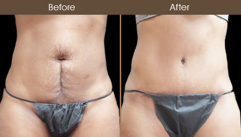 Tummy Tuck Surgery Before And After