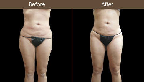 Before & After Lipo