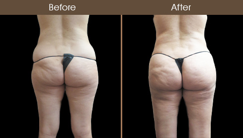 Before & After Liposuction Surgery