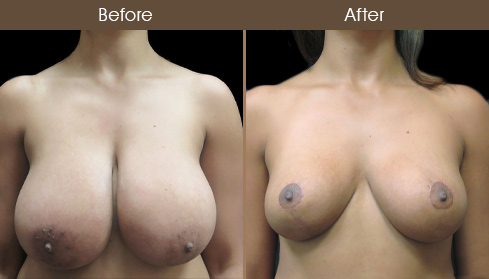 Before And After Breast Reduction In NYC
