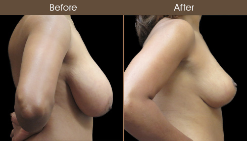 Before And After Breast Reduction Surgery In NYC