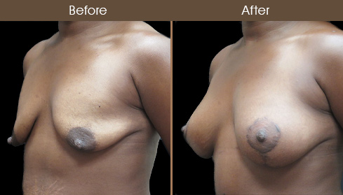 Mastopexy Surgery Before And After