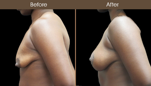 Before & After Mastopexy Surgery