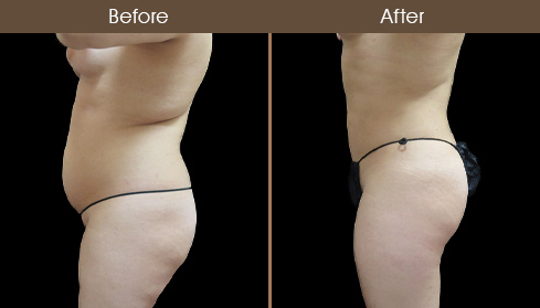 Lipo Before And After Left Side Image