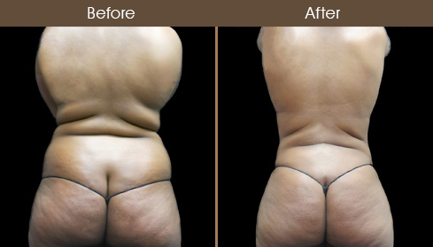 Abdominal Lipo Before And After Back Image