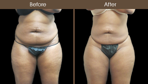 Abdominal Lipo Before And After Front Image