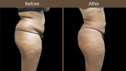 Abdominal Lipo Before And After Right Side Image