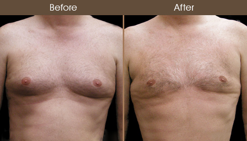 Male Breast Reduction Before & After