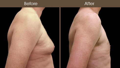 Before & After Male Breast Reduction