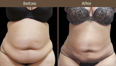 Liposuction Surgery Before & After