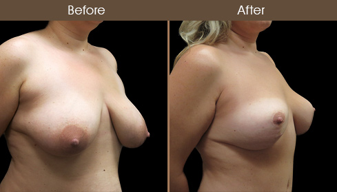 Before And After Breast Lift Right Quarter Image