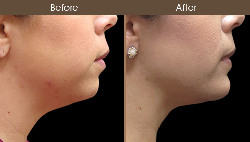 Before & After Chin Augmentation