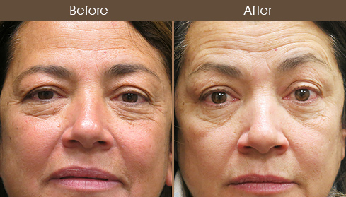 Before & After Eyelid Surgery
