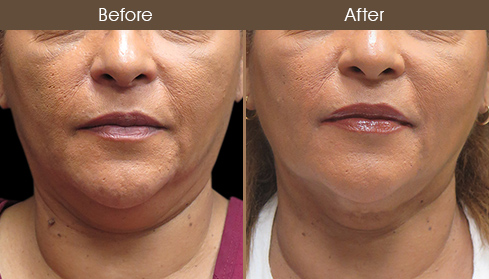 Scarless Neck Lift Results