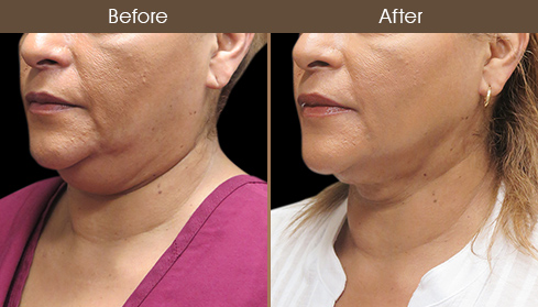 Before & After Scarless Neck Lift