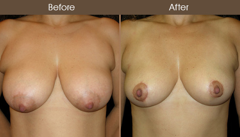NYC Breast Lift Before And After