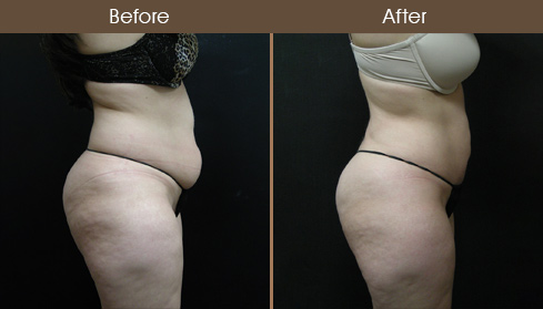 Lipo Surgery Before & After Side View
