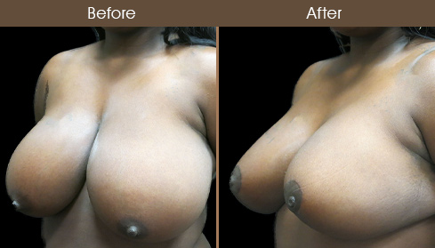 Before And After NYC Breast Reduction Surgery
