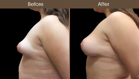 Before And After Breast Reconstruction
