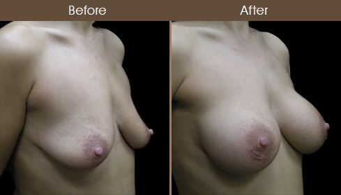 Breast Implant Surgery Before And After Right Quarter Image