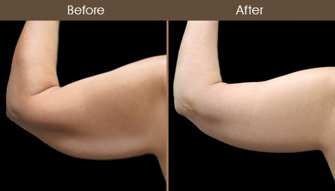 Before And After Arm Lift Back View