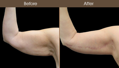 Before And After Arm Lift Front View