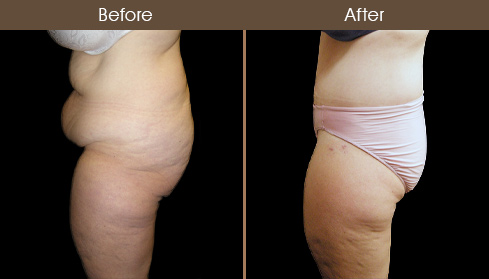 Body Lift Surgery Before & After