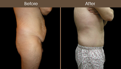 NYC Body Lift Surgery Before & After