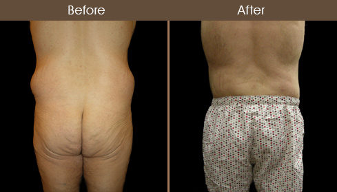 NYC Body Lift Surgery Before And After