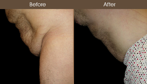 NYC Body Lift Surgery Results