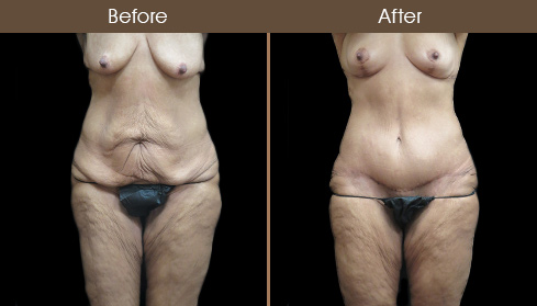 Before And After Body Lift Surgery In NYC