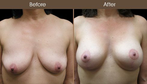 Breast Lift With Implants Before And After