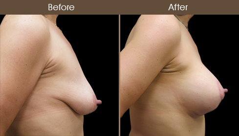 Breast Lift With Implants Results