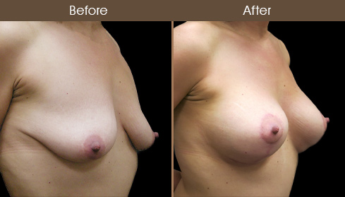 Before & After Breast Lift With Implants