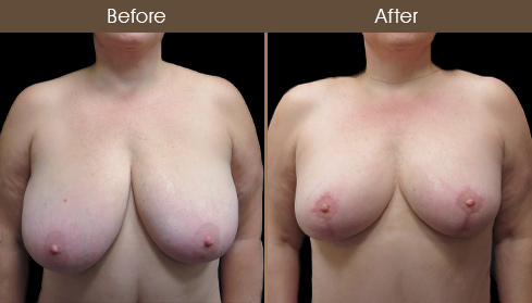 Before And After New York Breast Reduction