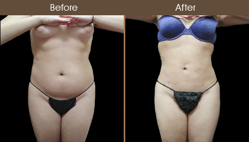 Lipo Before And After Front Image