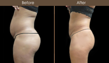 Before And After Liposuction Surgery In NY