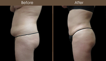 NY Liposuction Before & After