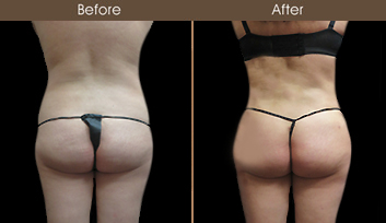 Before & After New York City Liposuction Surgery