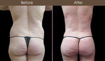 Before & After Gluteal Fat Grafting